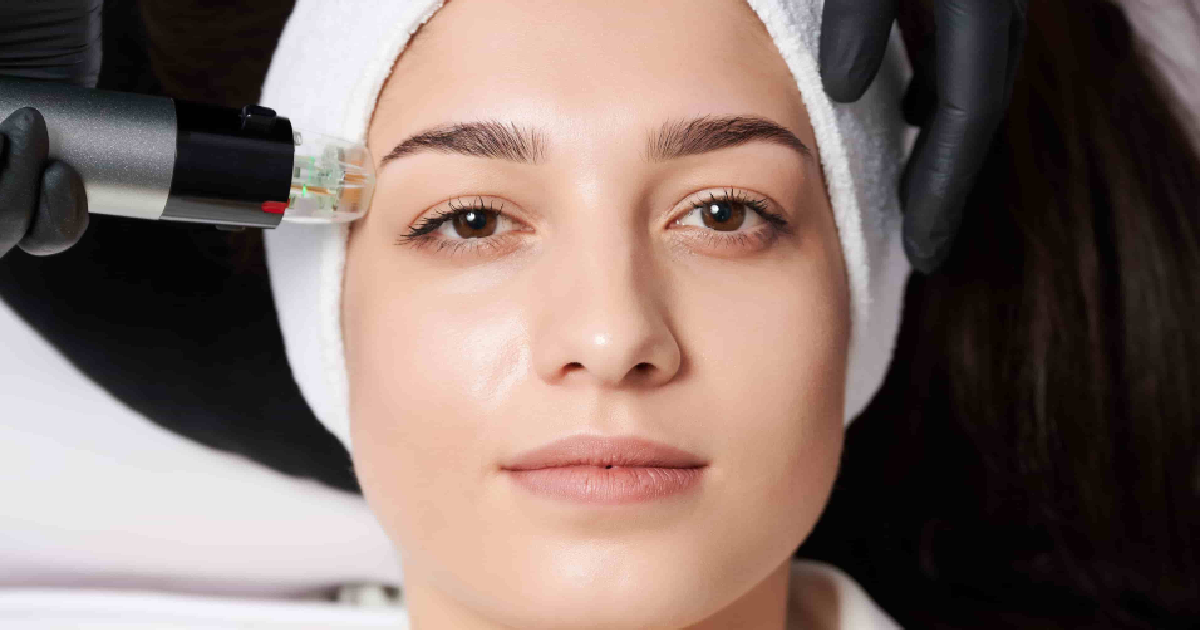 Young woman with a headband undergoing a microneedling facial treatment by a professional wearing black gloves in St. Charles, IL